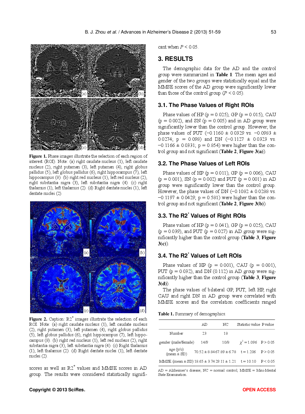 The Evaluation Of Iron Content In Alzheimer’s Disease By Magnetic Resonance Imaging: Phase And R2* Methods - Page 4